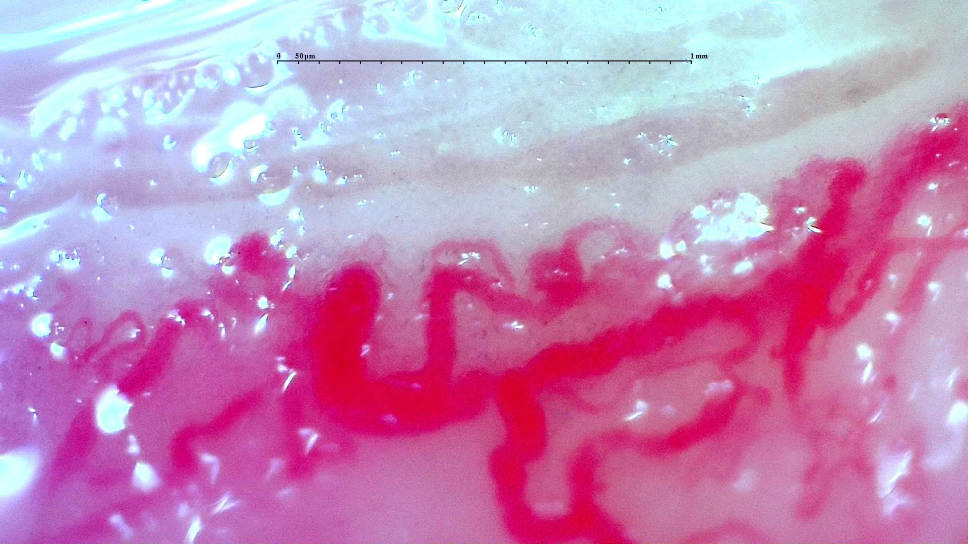 Nailfold capillaroscopy: left index finger, field d. Anti-TIF1γ Dermatomyositis with Scleroderma-Like Pattern.