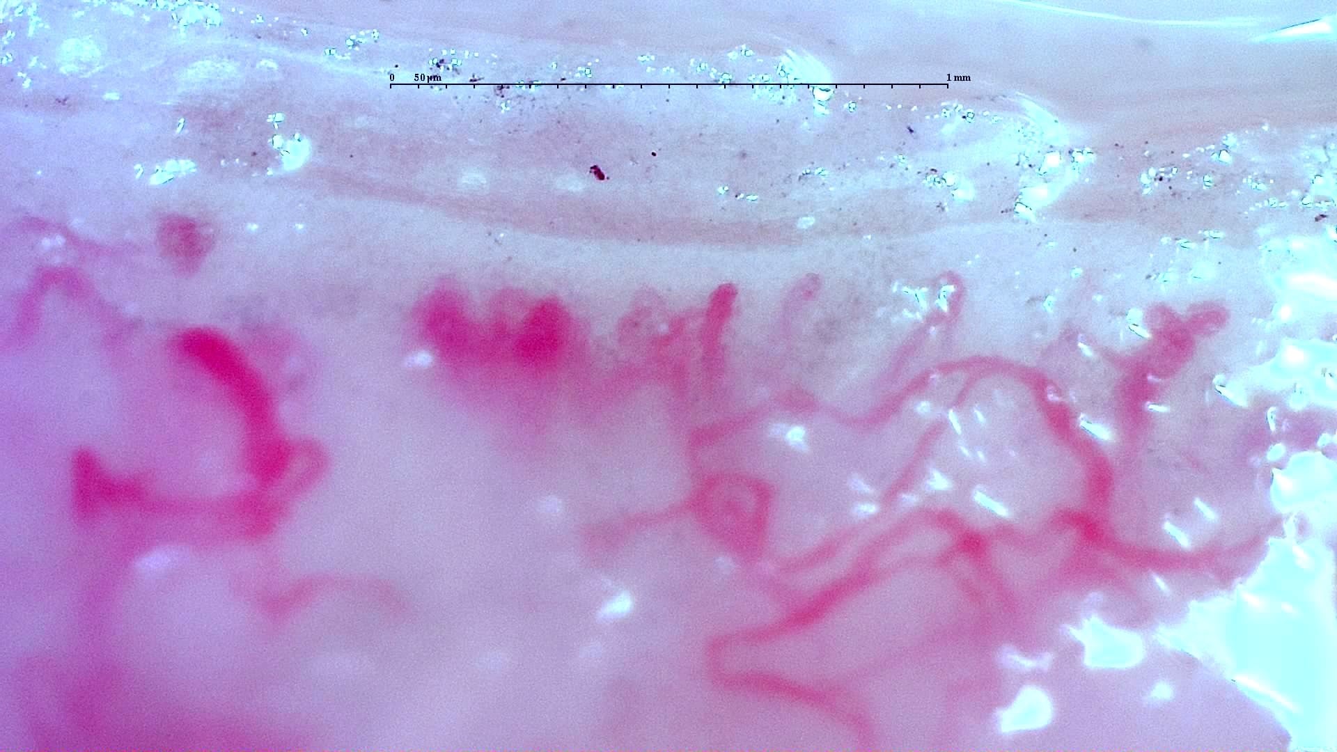 Nailfold capillaroscopy: left index finger, field c. Anti-TIF1γ Dermatomyositis with Scleroderma-Like Pattern.