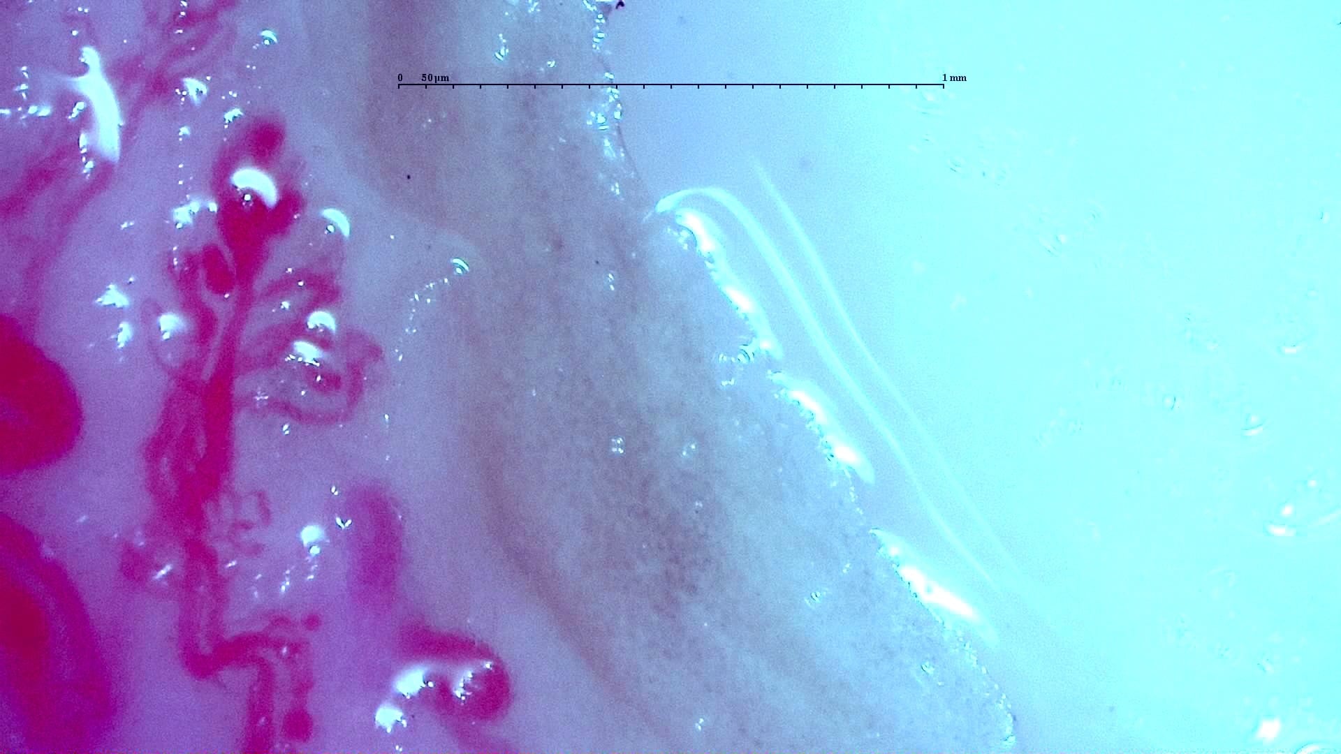 Nailfold capillaroscopy: left middle finger, field b. Anti-TIF1γ Dermatomyositis with Scleroderma-Like Pattern.