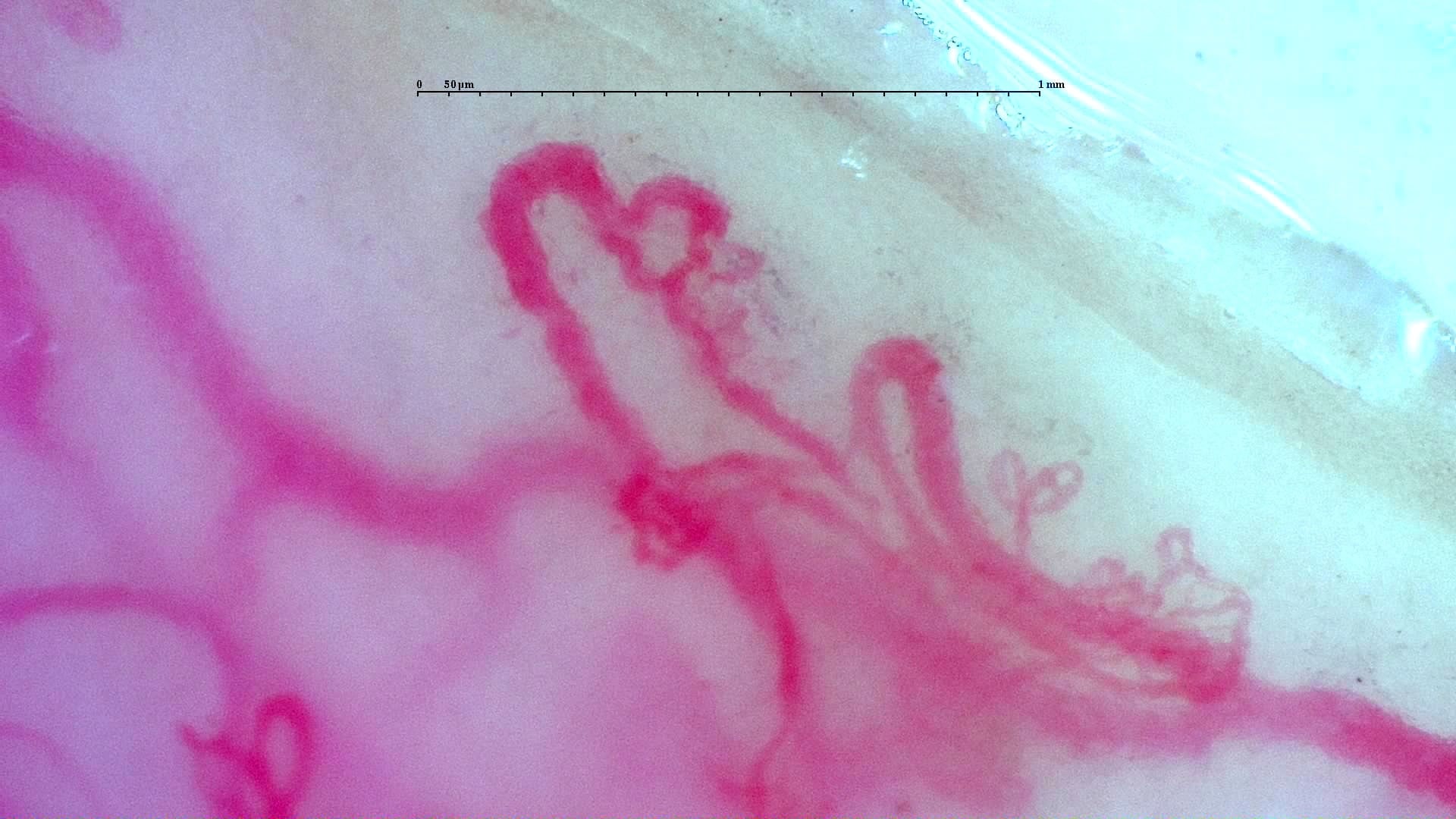 Nailfold capillaroscopy: left index finger, field b. Anti-TIF1γ Dermatomyositis with Scleroderma-Like Pattern.