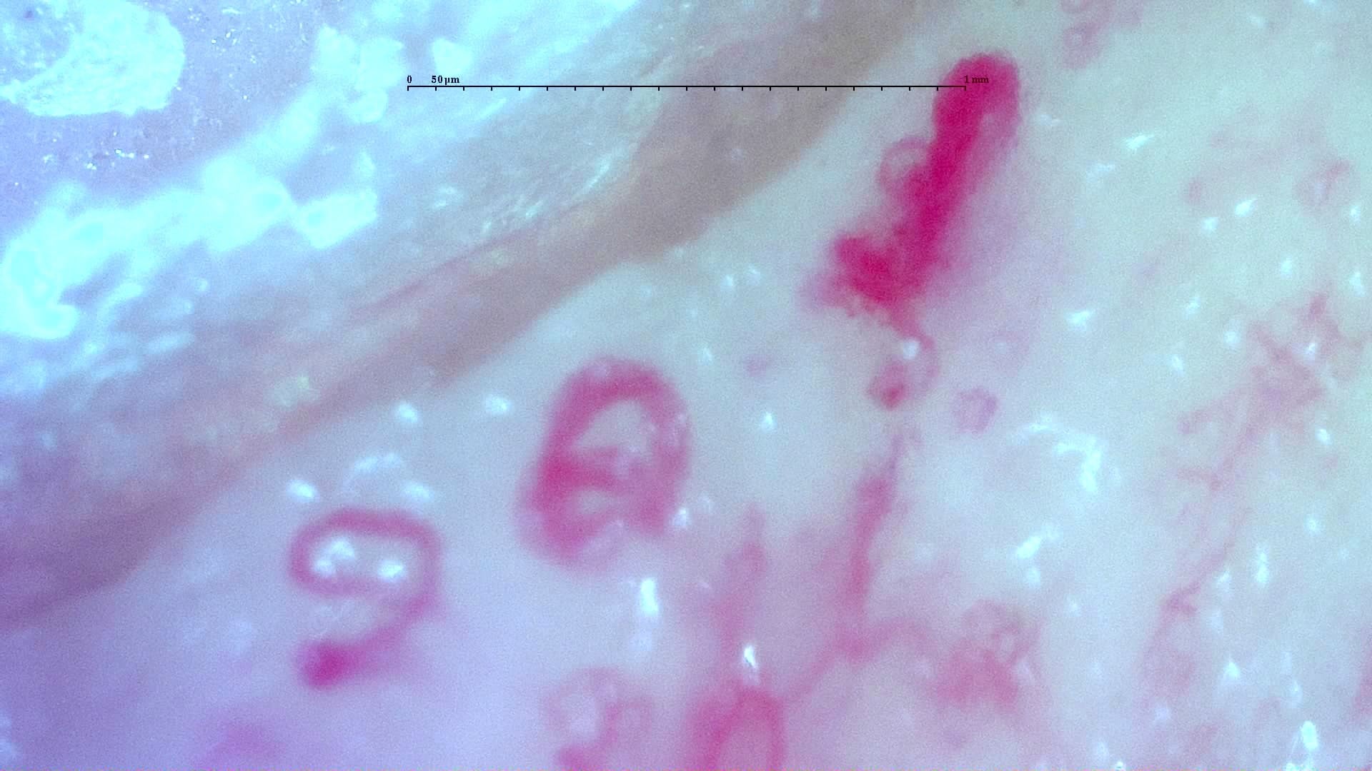 Nailfold capillaroscopy: right index finger, field c. Anti-TIF1γ Dermatomyositis with Scleroderma-Like Pattern.