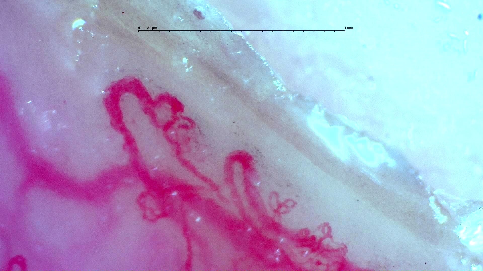 Nailfold capillaroscopy: left little finger, field d. Anti-TIF1γ Dermatomyositis with Scleroderma-Like Pattern.