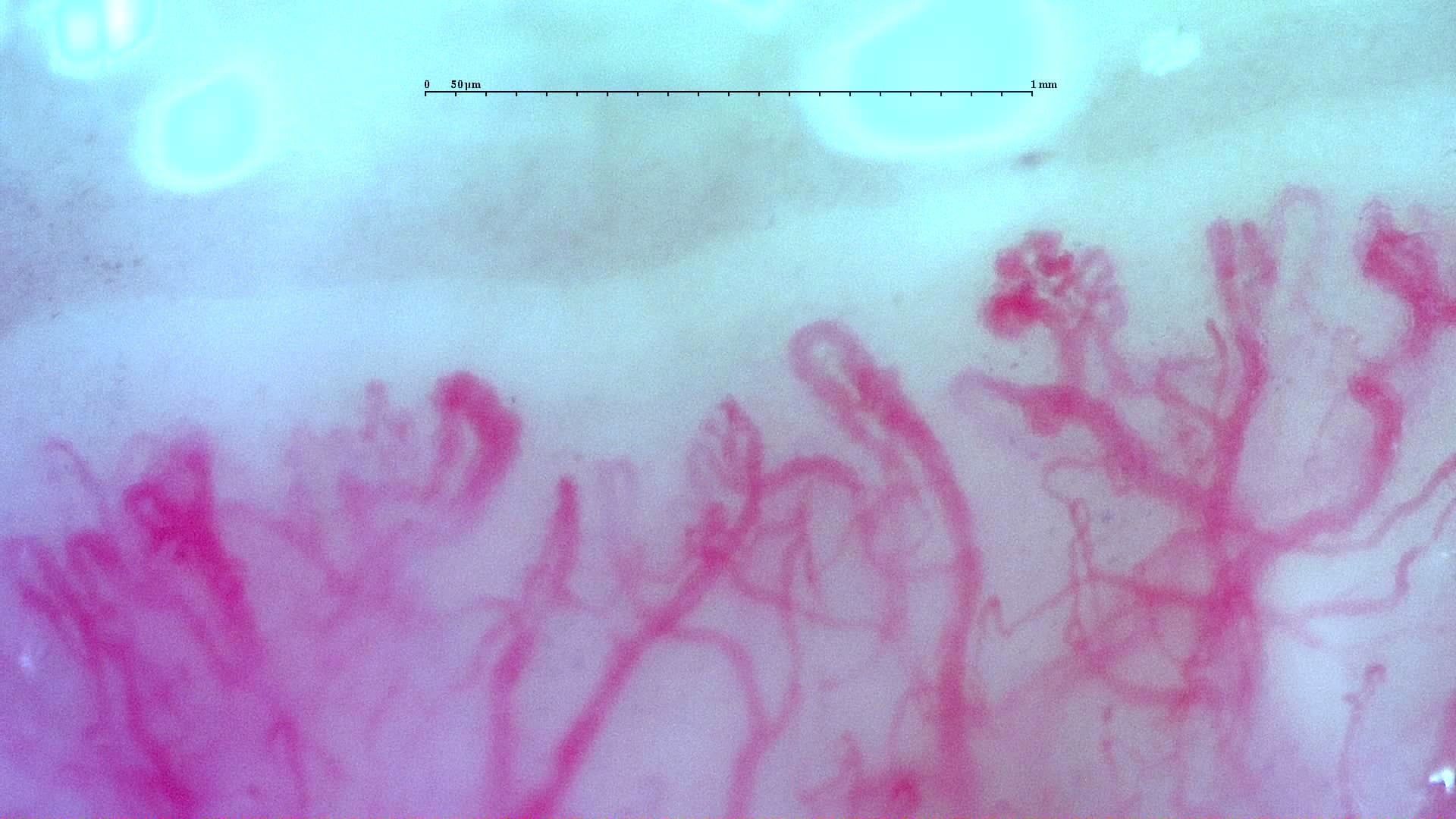 Complex, winding and ramified vascular forms in the anti-TIF1γ dermatomyositis case. A scleroderma-like image appearance does not establish systemic sclerosis.