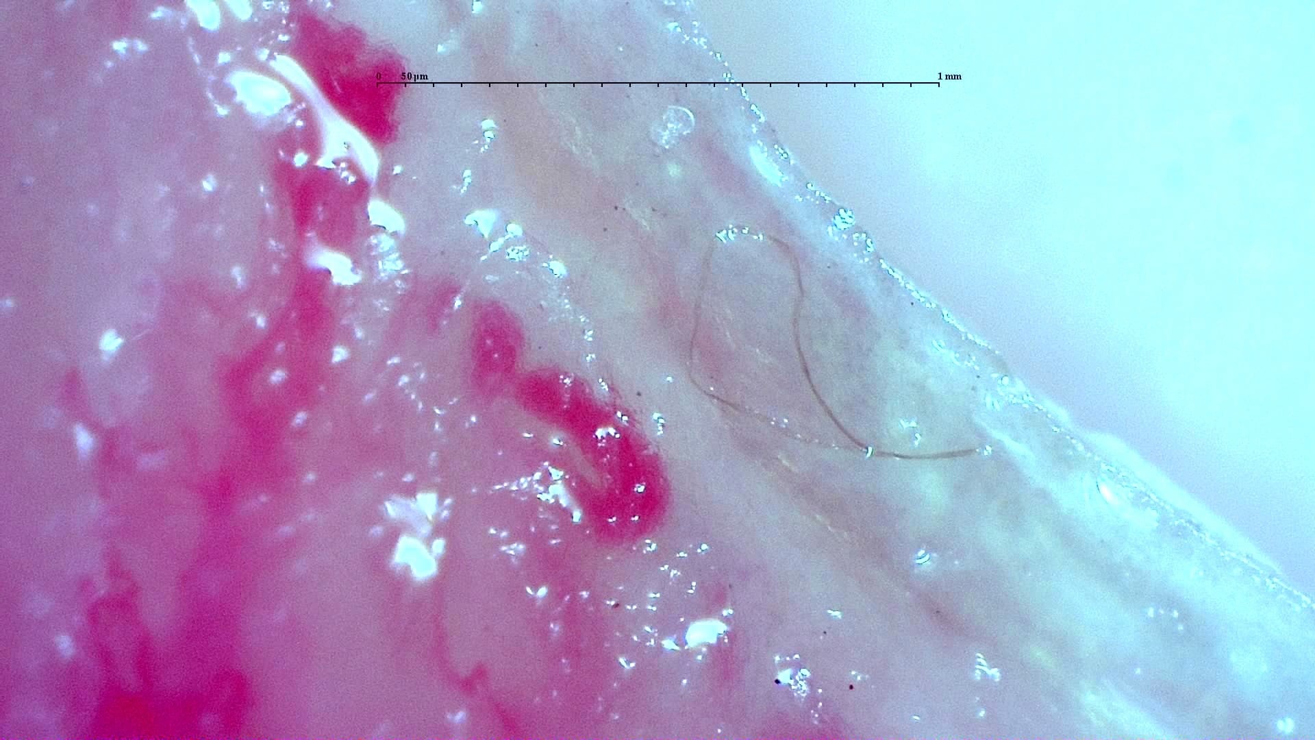 Nailfold capillaroscopy: right index finger, field b. Anti-TIF1γ Dermatomyositis with Scleroderma-Like Pattern.